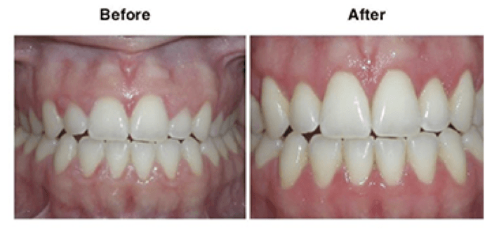 Gum Treatment