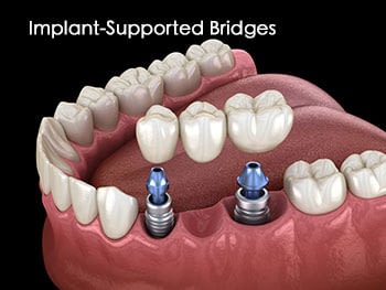 Implant Supported Bridges 