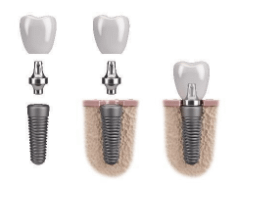 A diagram of Dental Implant