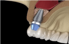 Dental Implant in the bone (diagram)