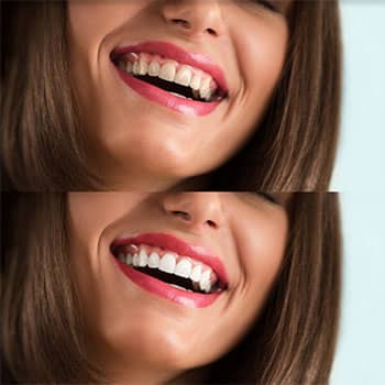 before and after teeth whitening in phuket