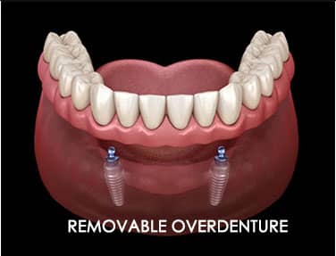 Removable Overdenture supported 2 dental implants