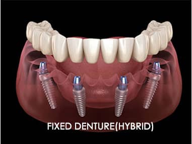 Hybrid supported by all-on-4 dental implant